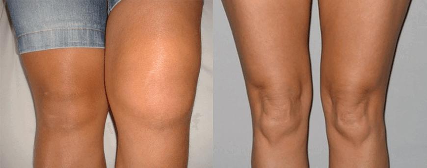 Expériences d'utilisation de capsules d'huile de cannabis avant et après l'utilisation d'Eva